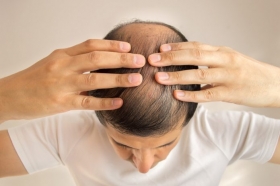 1 de cada 2 hombres de entre 20 y 30 a&ntilde;os tiene alopecia androgen&eacute;tica.