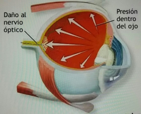El glaucoma cr&oacute;nico es considerado como el enemigo silencioso porque no da s&iacute;ntomas en su etapa inicial 
