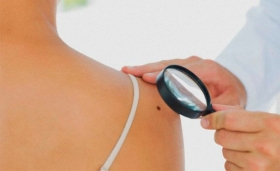 Identificar el c&aacute;ncer de piel tipo melanoma, a trav&eacute;s de la t&eacute;cnica del &ldquo;ABCDE&rdquo;